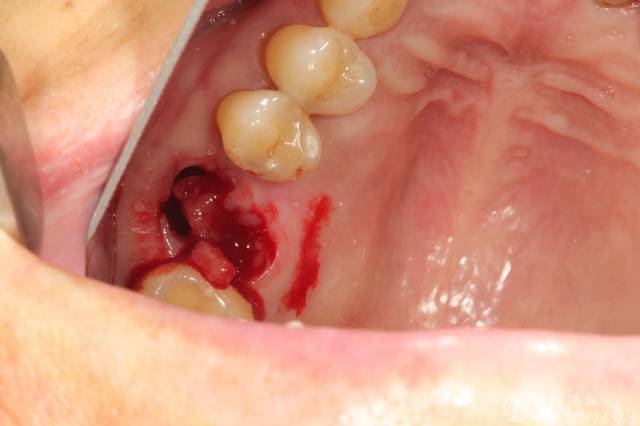 左上后牙巨大拔牙窝即刻种植 右下前磨牙简单即刻种植一例