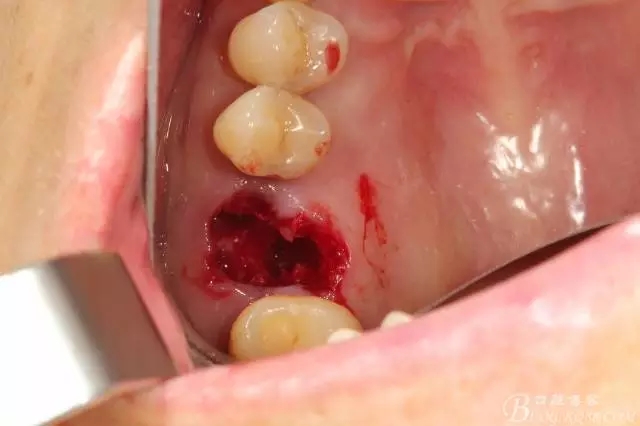 左上后牙巨大拔牙窝即刻种植 右下前磨牙简单即刻种植一例